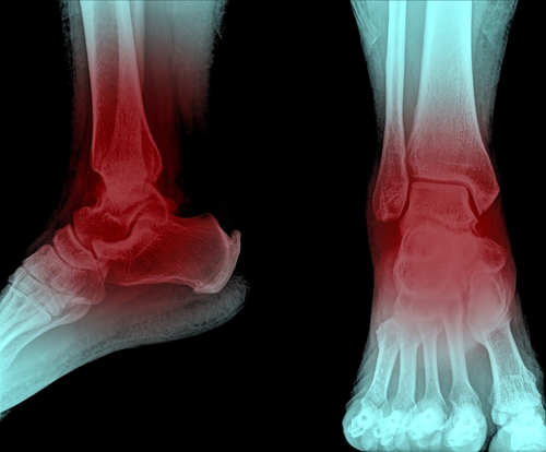 needle pain in heel