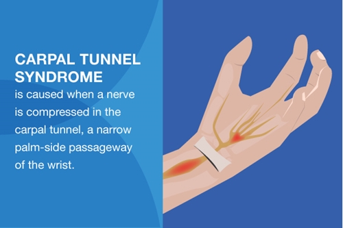 Graphic showing anatomy of the carpal tunnel along the palm side of the wrist.